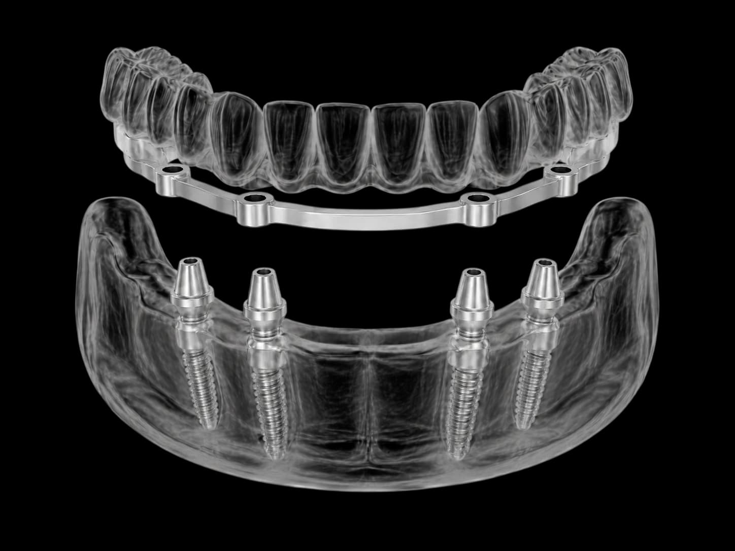 Illustration of All-on-4 dental implants with titanium bar and full-arch teeth