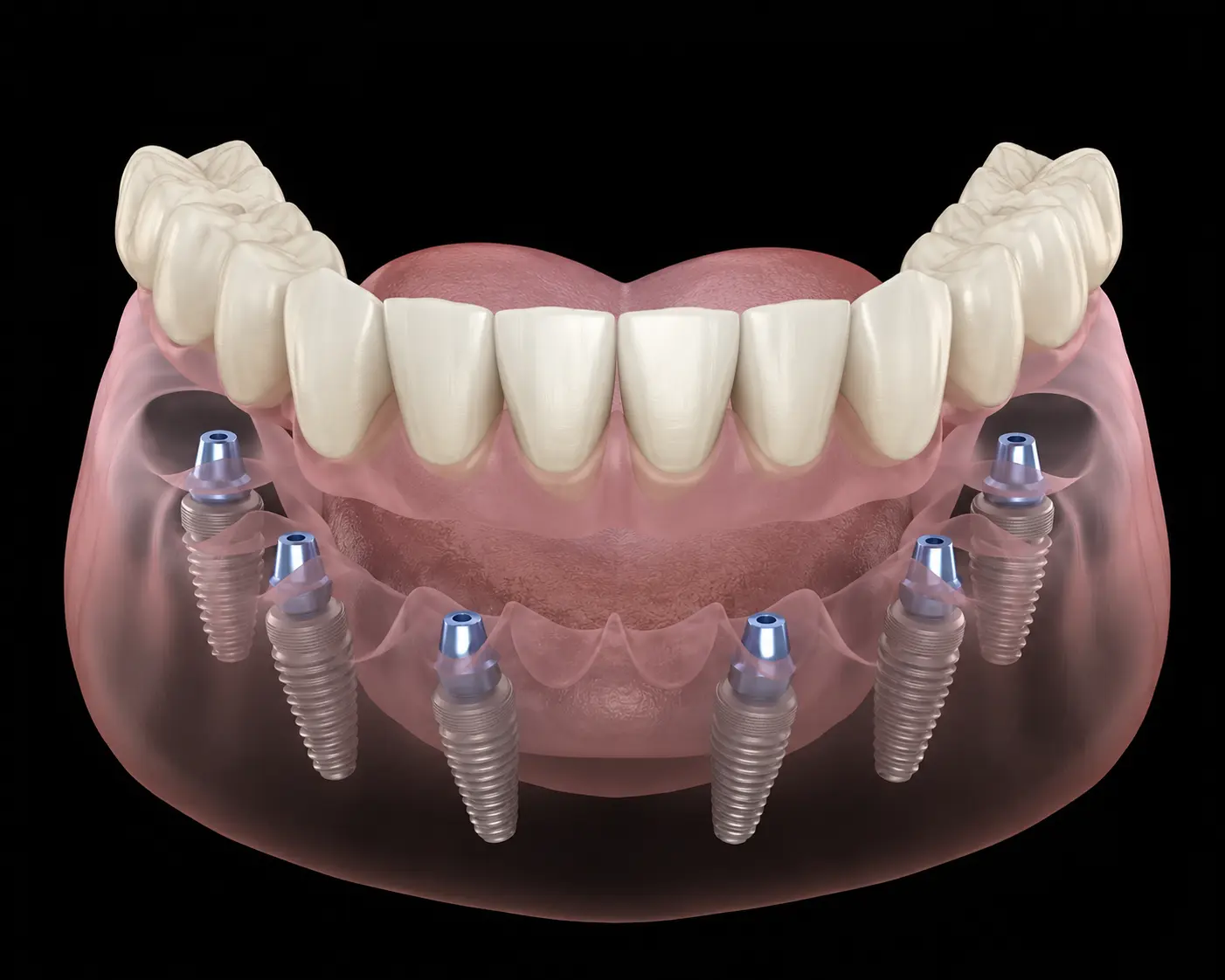 All-on-6 full-arch dental implant model at SQ Dentist International