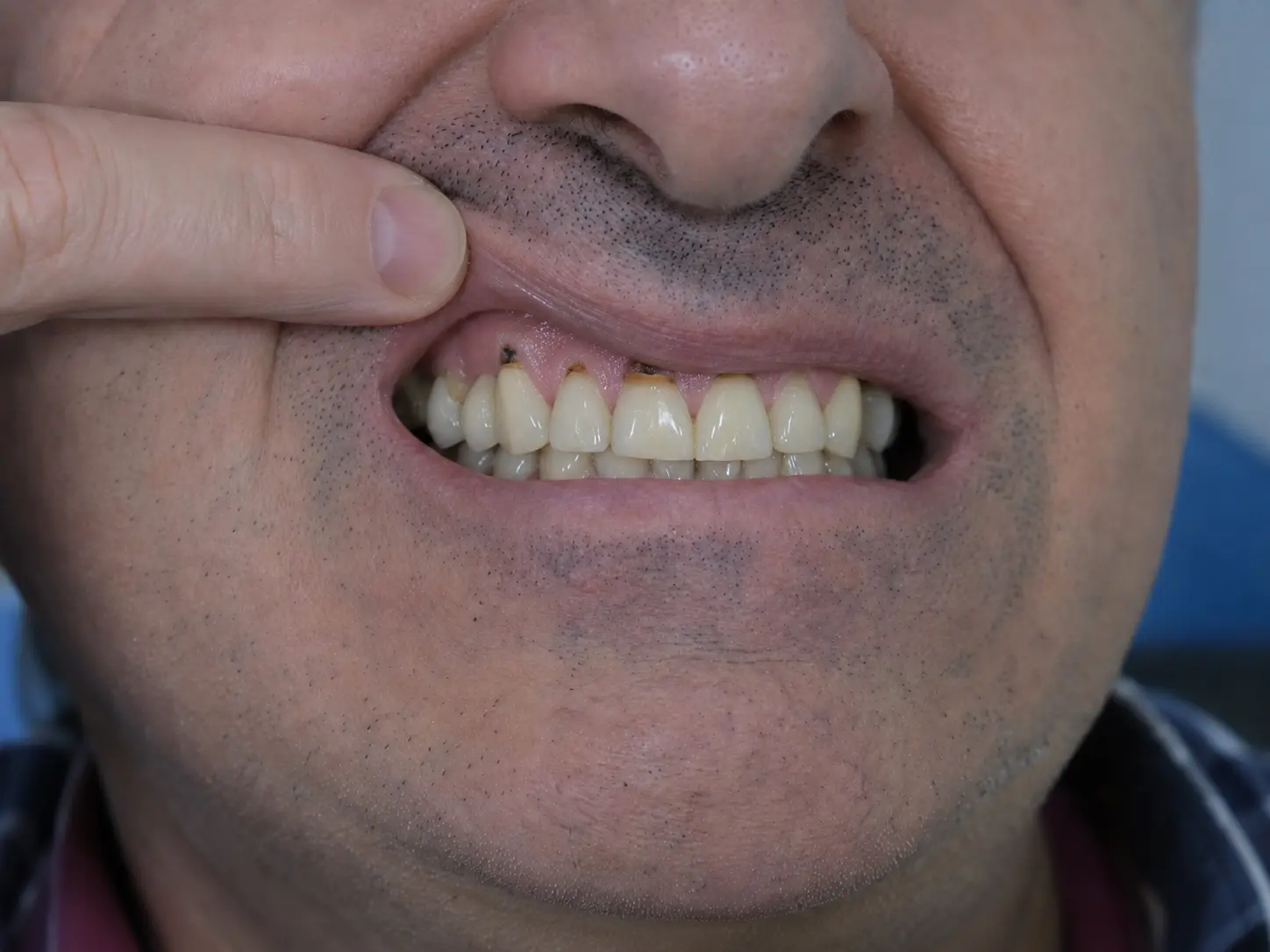 Complex previous dental work reviewed for full-arch implant treatment