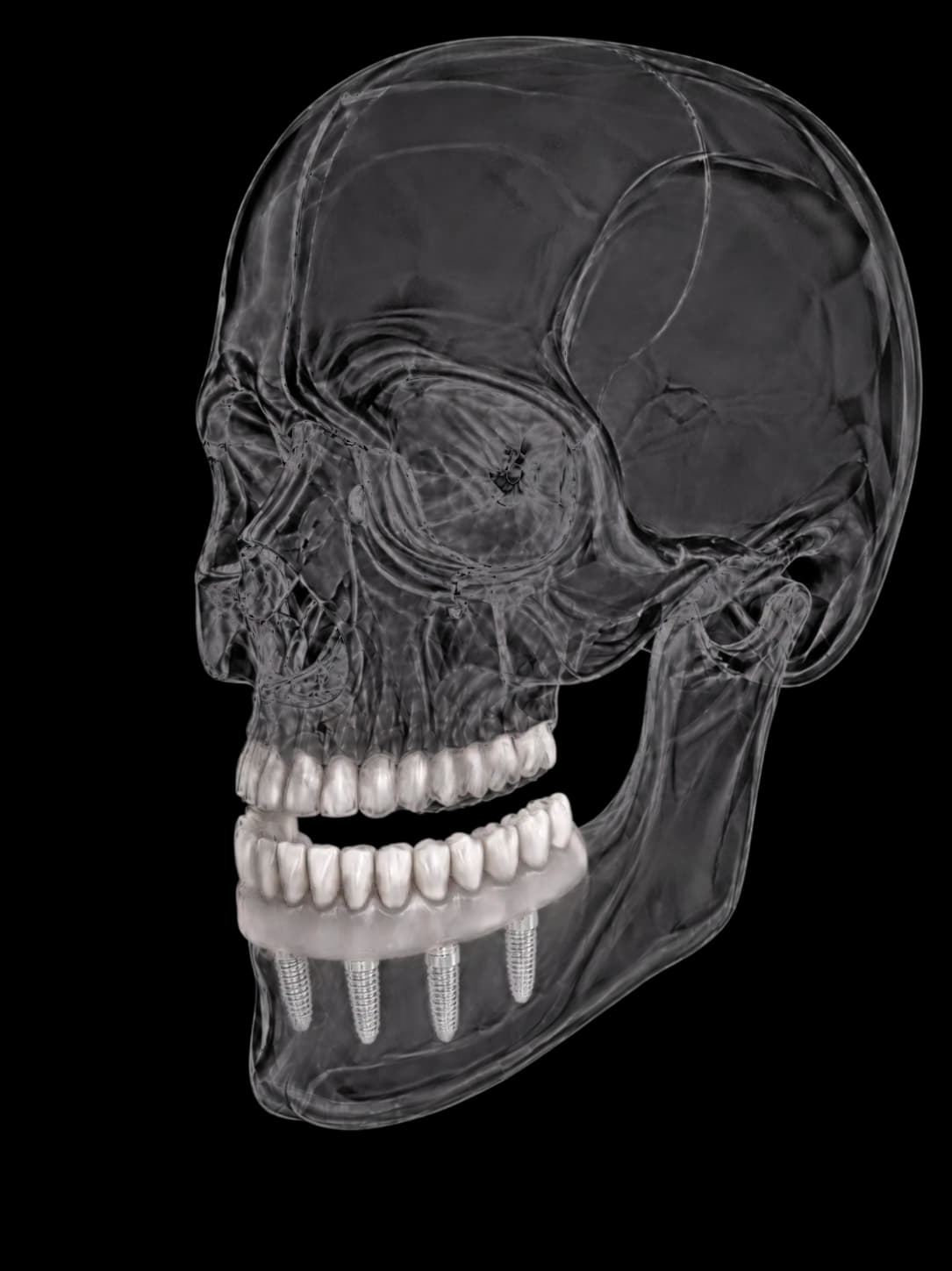 3D skull model showing implant positions used to plan All-on-4 and All-on-6 treatment