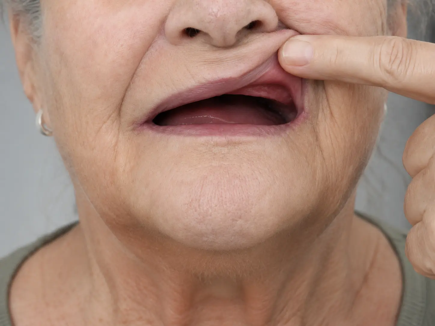 Full-arch tooth loss case for All-on-4 and All-on-6 dental implants